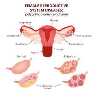 PCOS Treatment at Ojas Ayuved in Pune